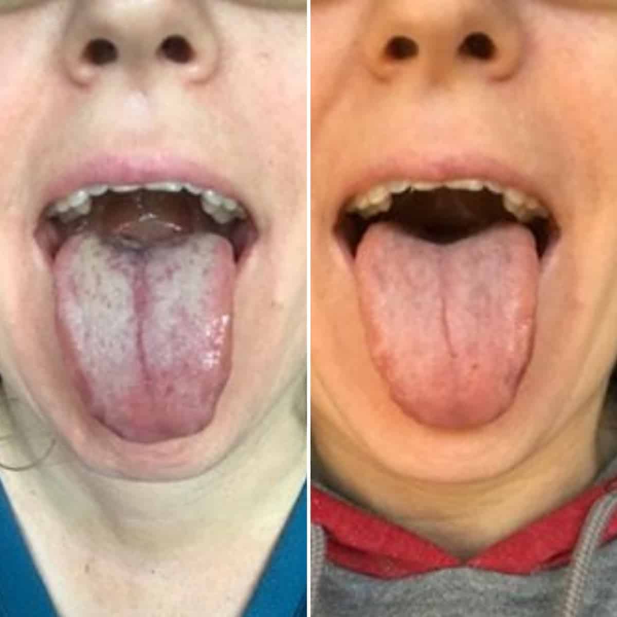 Before and after oral chronic yeast infection